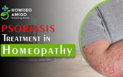 Psoriasis Treatment in Homeopathy: A Natural Approach to Find Relief