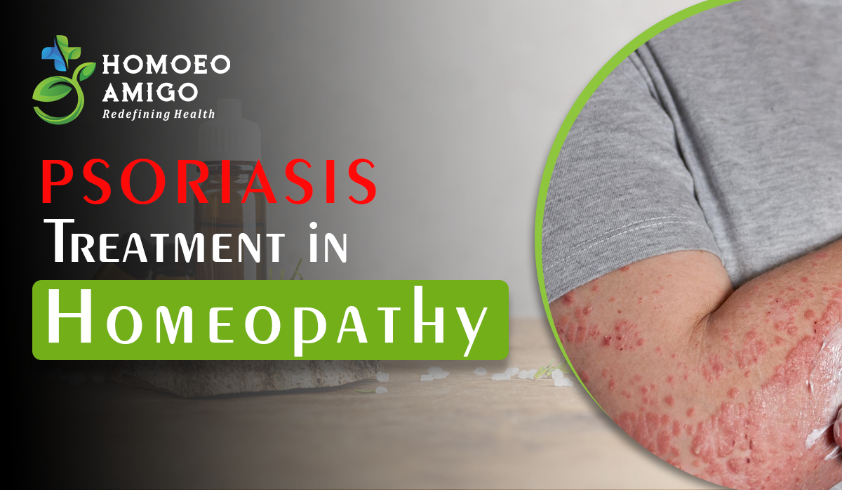 Psoriasis Treatment in Homeopathy - Homoeo Amigo