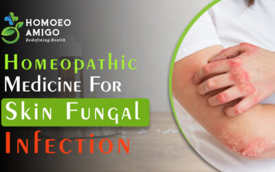 Best Homeopathic Medicine For Skin Fungal Infection