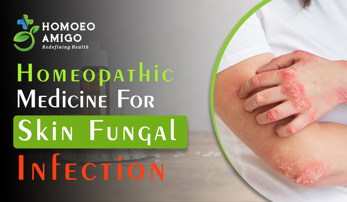 Homeopathic Medicine For Skin Fungal Infection - Homoeo Amigo