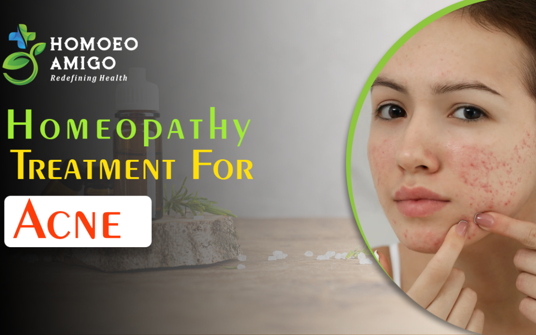 Homeopathic Treatment for Acne – Achieving Clear Skin Naturally