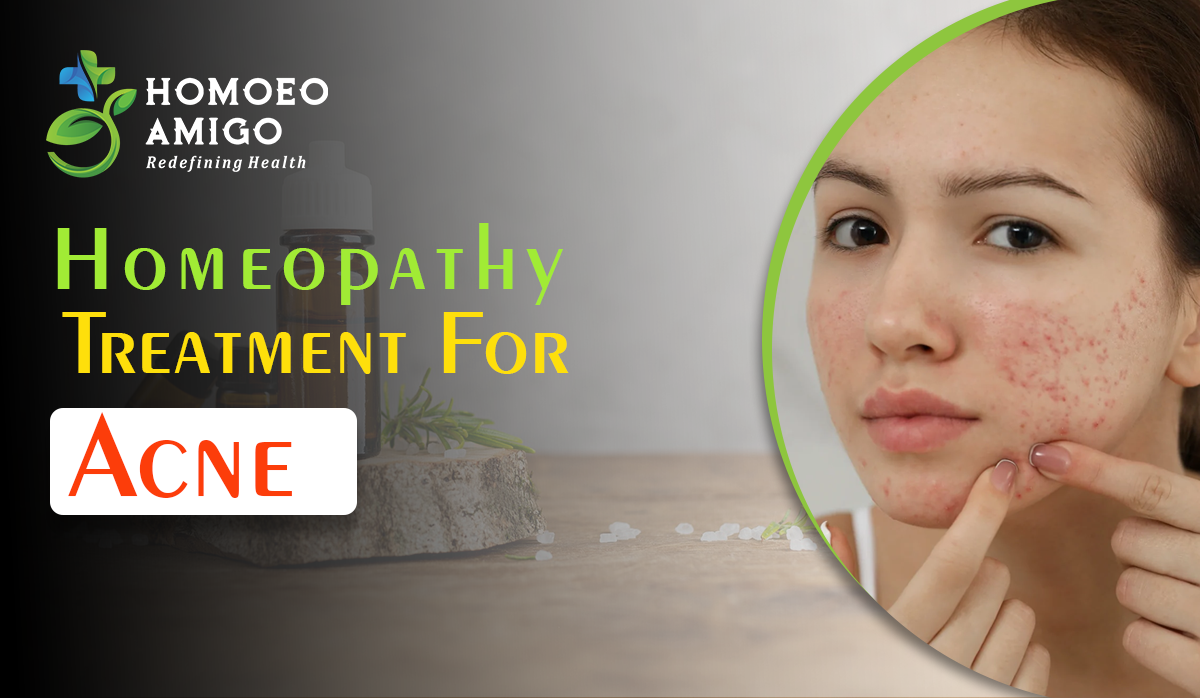 Homeopathic Treatment for Acne - Achieving Clear Skin Naturally - Homoeo Amigo