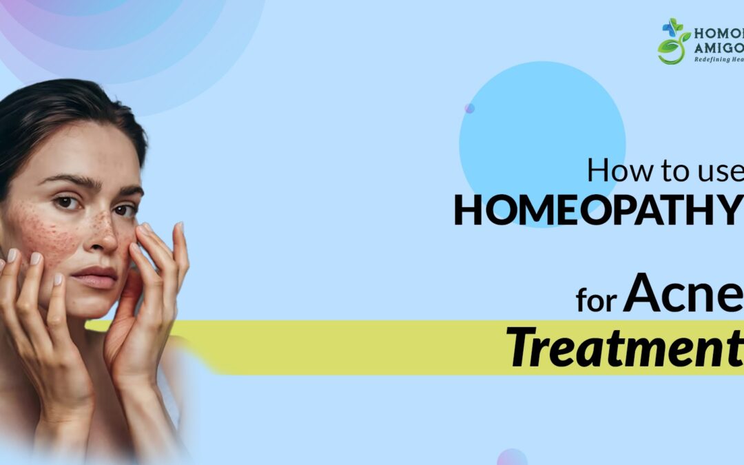 How to Use Homeopathy for Acne Treatment