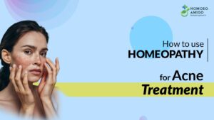 How to Use Homeopathy for Acne Treatment