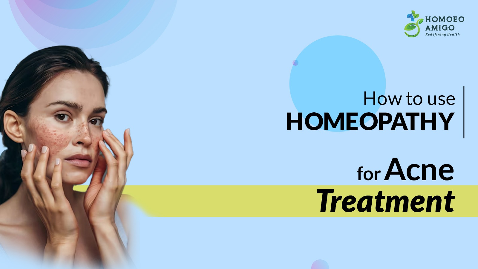 Acne Homeopathic Treatment