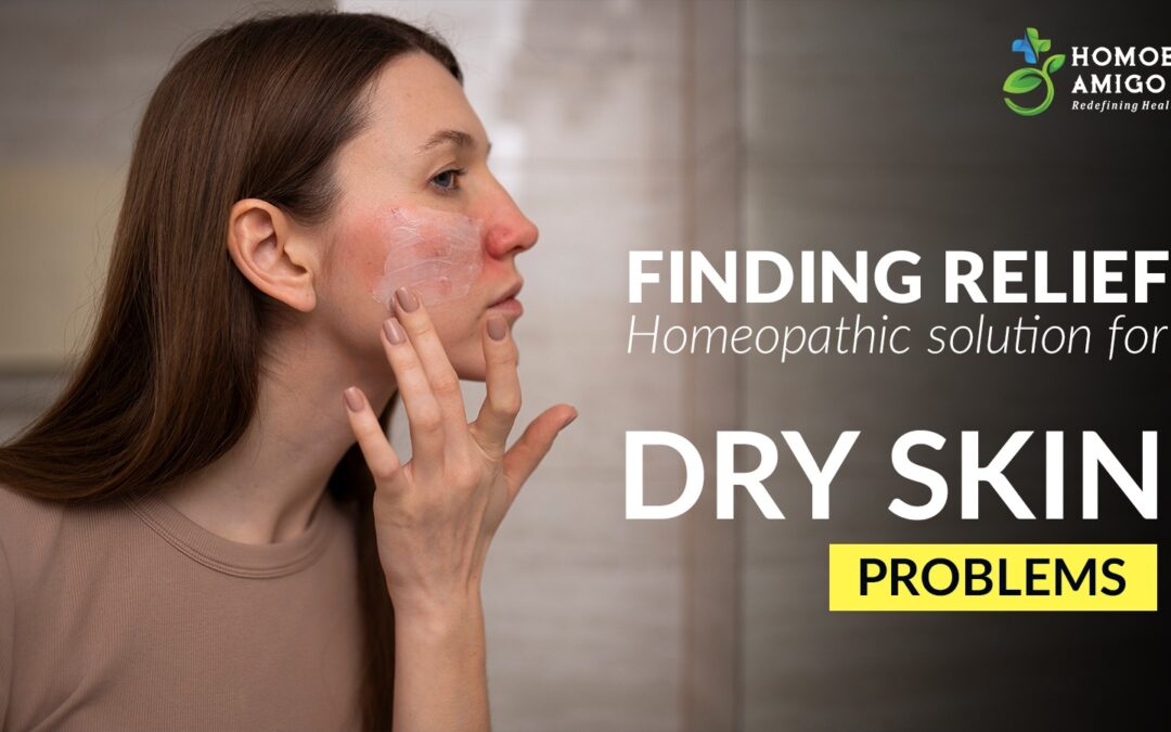 Finding relief : Homeopathic solution for dry skin problems