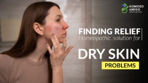 Finding relief : Homeopathic solution for dry skin problems